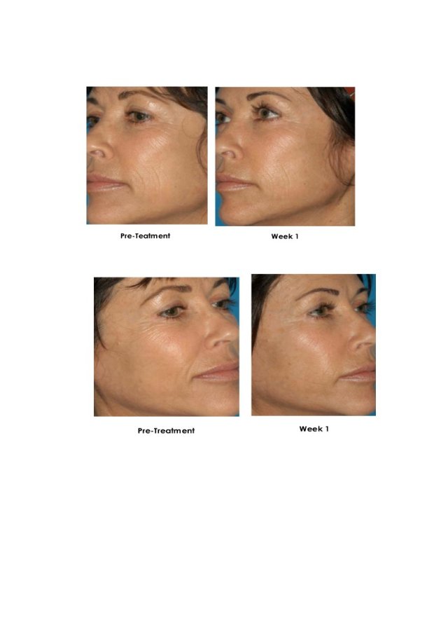 Before and After Treatment Results 4